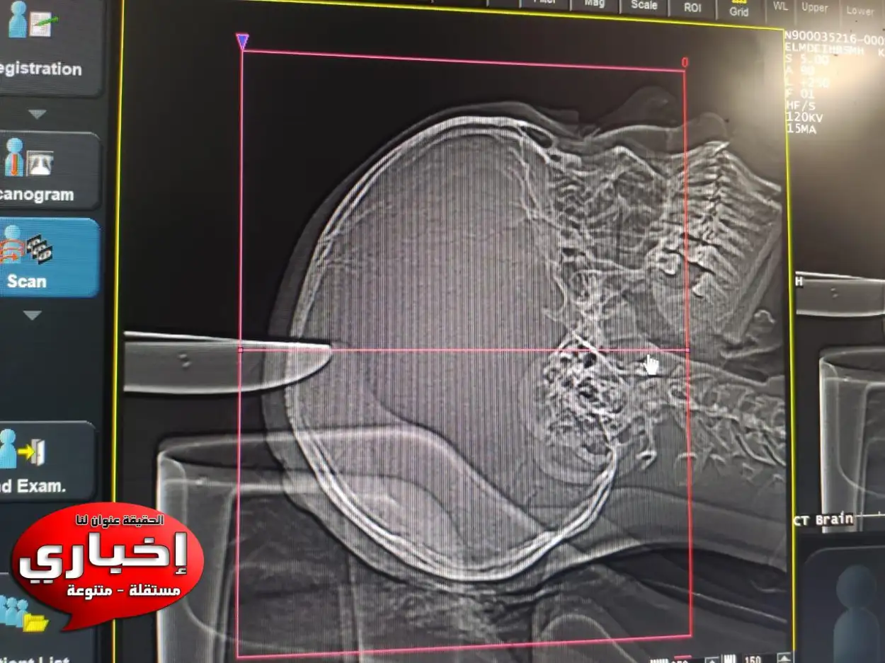  إيقاف نزيف بالمخ لطفله بعد طعنها بسكين فى الرأس